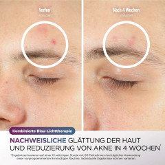 CryoGlow LED-Maske + Kühlung der Augenpartie – FW312EU (Hautpflegemaske) | 36080000996_08